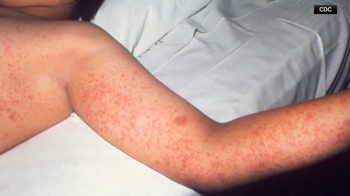 Measles case reported in Buffalo Township, Butler County