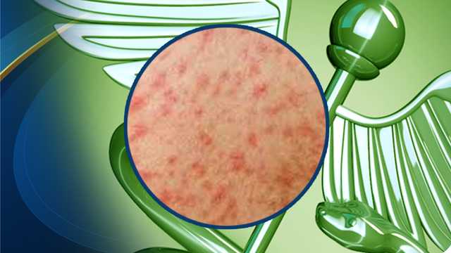 Maine measles case under investigation by state's CDC - Vimarsana News