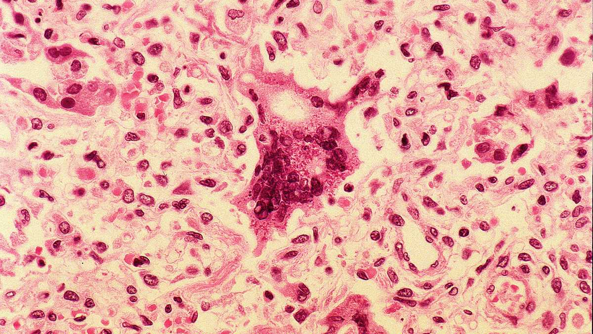 Maine CDC reports 6th measles case of 2026, warns of potential exposure in Waterville