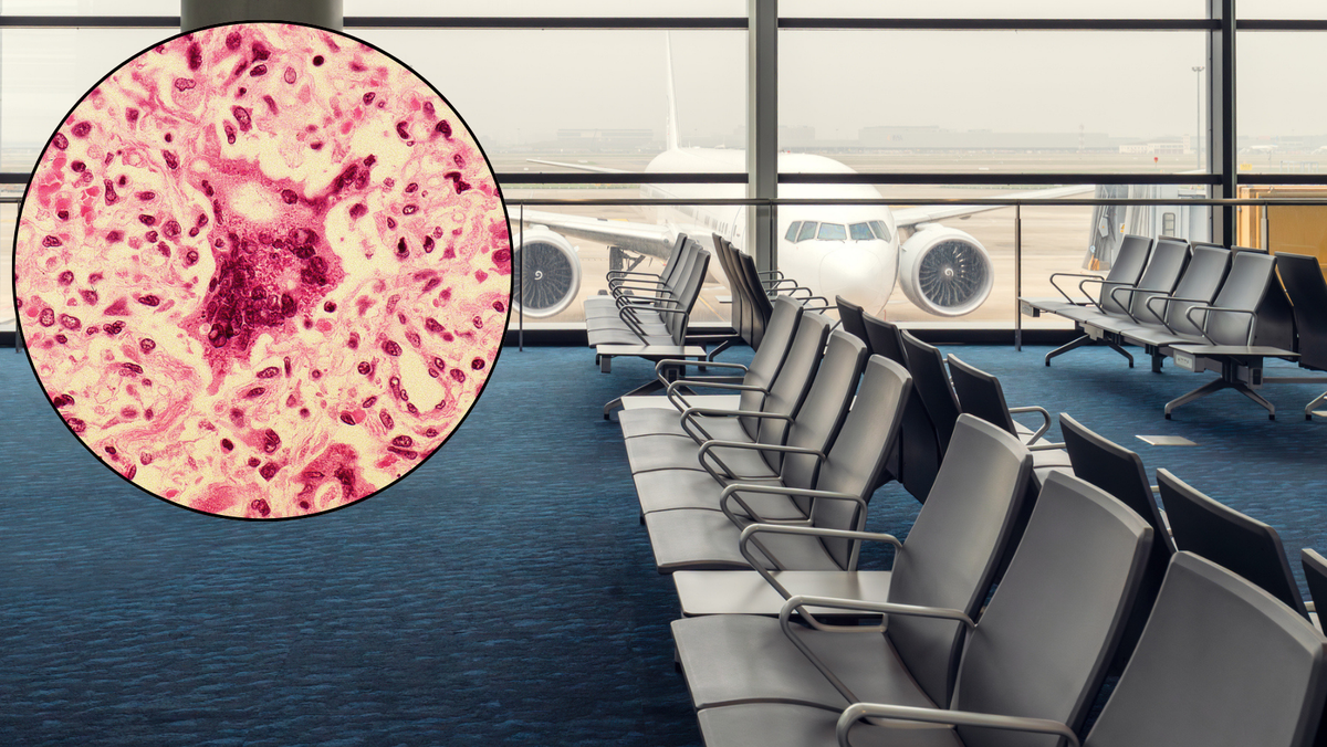 Ohio health officials warn of potential measles exposure at Columbus Airport