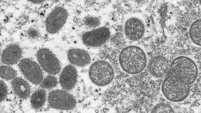 O Departamento de Saúde de Ohio identifica um possível caso de varíola dos macacos