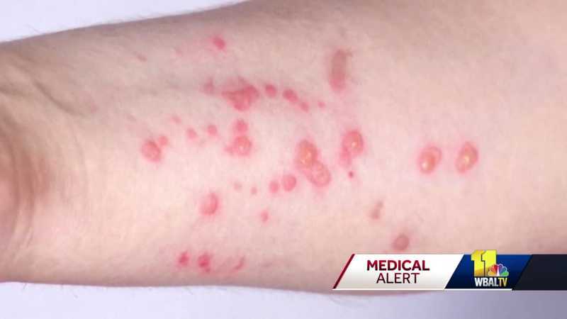 Hogan: Maryland ramps up monkeypox testing, vaccinations - Vimarsana News