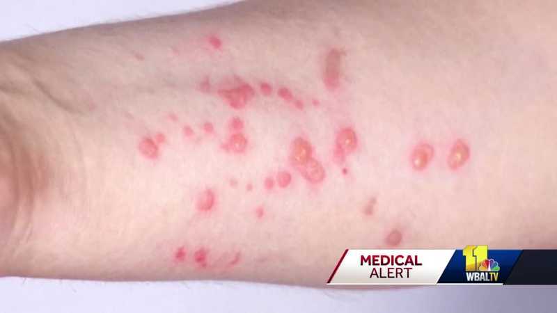 Monkeypox: What Is It, Causes, and More