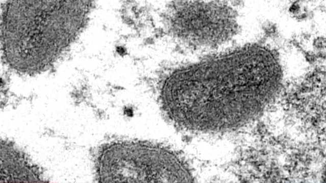 New Hampshire monkeypox vaccine sites open, more to come - Vimarsana News