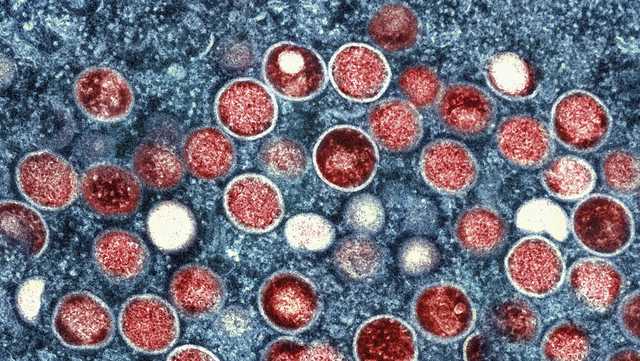 Ohio Health Department creates Monkeypox dashboard for cases, updates - Vimarsana News