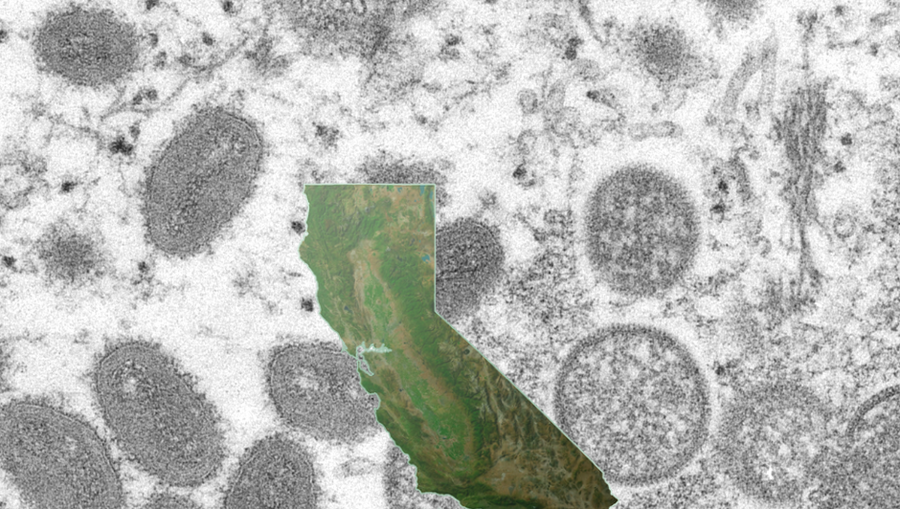 San Benito County reports its first case of monkeypox