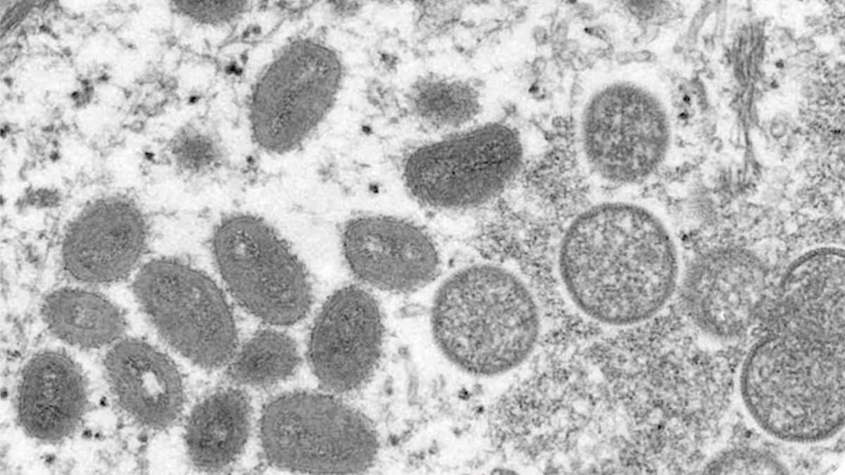 新罕布什尔州报告了首例儿童猴痘病例