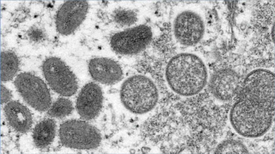 Health Department posts ways monkeypox can be spread as cases rise - Vimarsana News