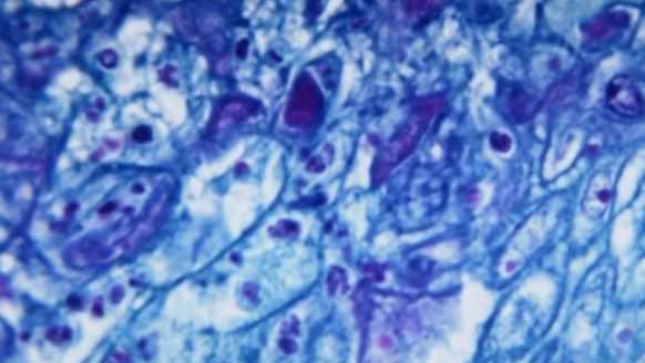 Monkeypox in Florida: First pediatric case confirmed - Vimarsana News