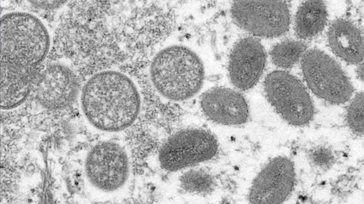 North Carolina Mpox cases are increasing statewide WXII12 WinstonSalem North Carolina Mpox cases are increasing statewide WXII12 WinstonSalem