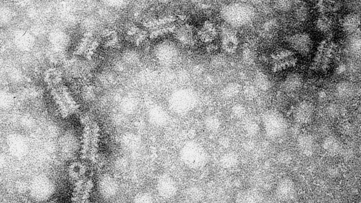 Health Department confirms case of mumps in KCMO