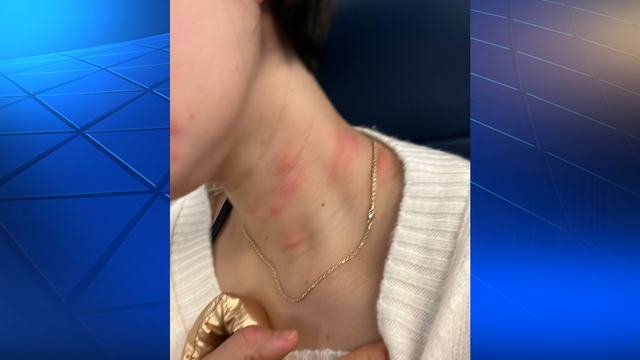 NC woman claims bed bugs bit her during stay at Pittsburgh hotel - Vimarsana News
