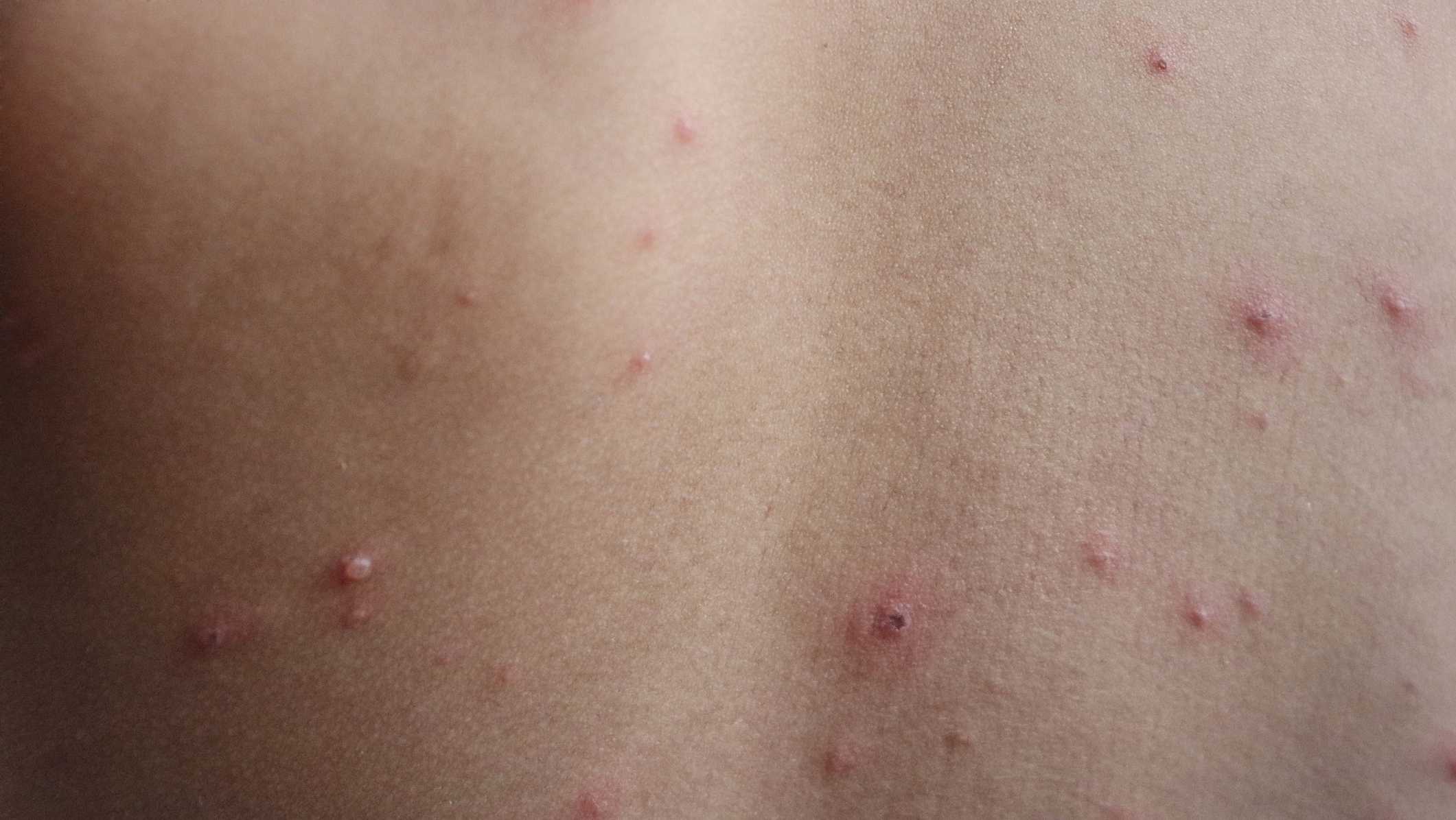 Cases of measles confirmed in New Mexico, first since 2021 - Vimarsana News