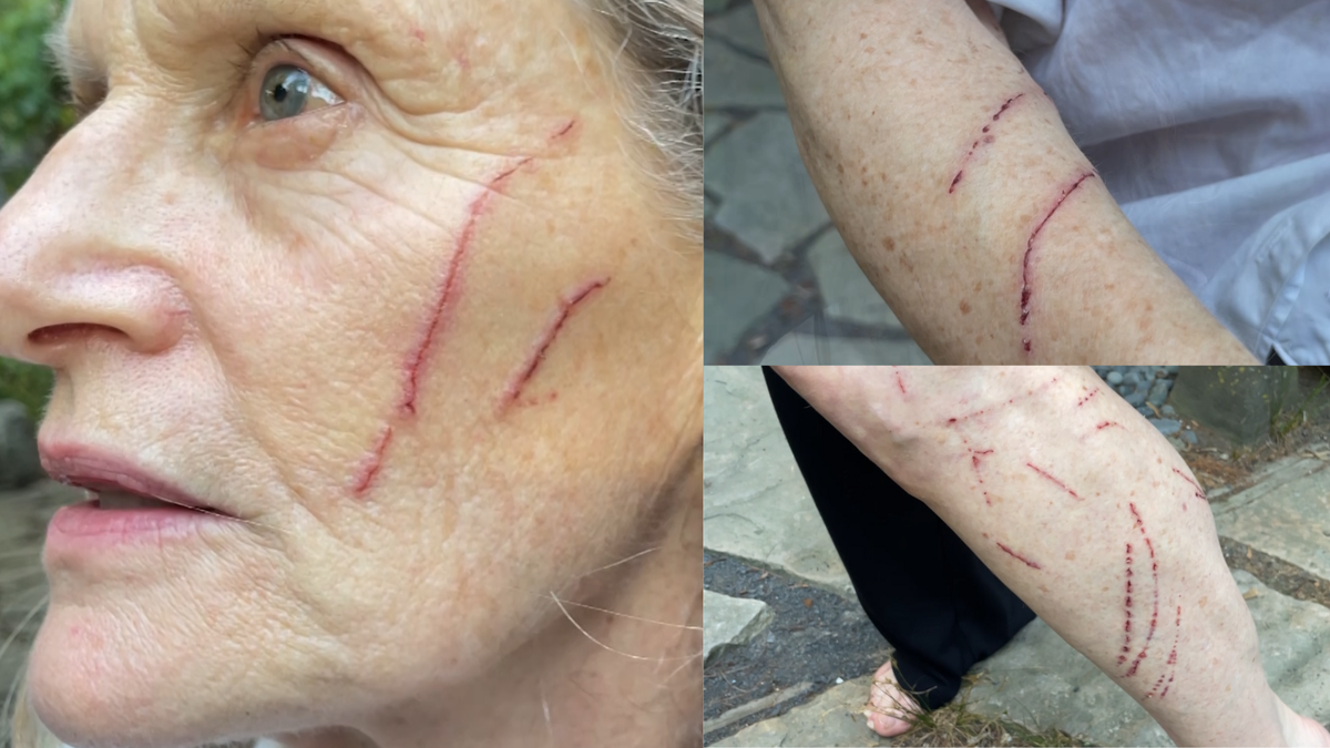 Massachusetts Woman Injured in Rare Raccoon Attack