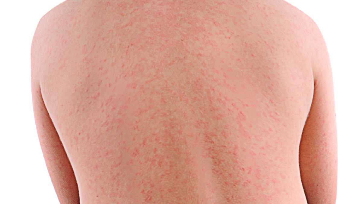 South Carolina health officials report measles case in Hampton County