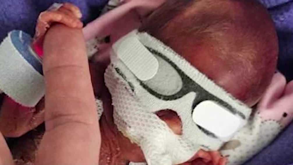 Waukee 'micro-preemie' born just before 22 weeks in NICU at Iowa hospital