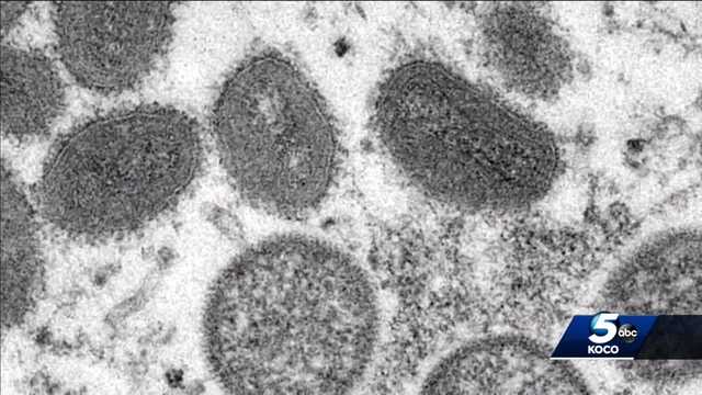 State of Oklahoma reports potential first monkeypox case - Vimarsana News