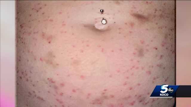Visitors to Lake Eufala developing bizarre rash - Vimarsana News
