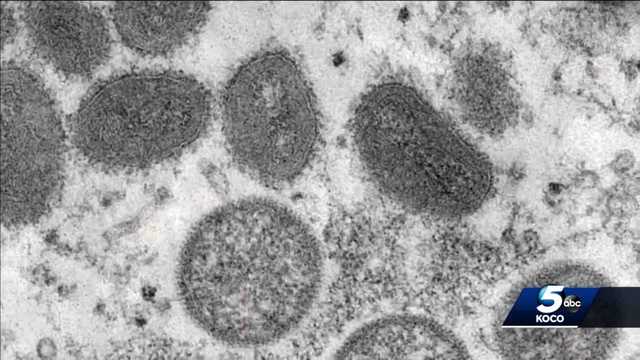 Bratzler: Monkeypox spreads through skin contact, contaminated items - Vimarsana News