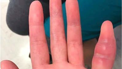 A 42-year-old woman who sought treatment after a week of swelling and discomfort in her left pinky finger was discovered to be infected with Mycobacterium tuberculosis.
