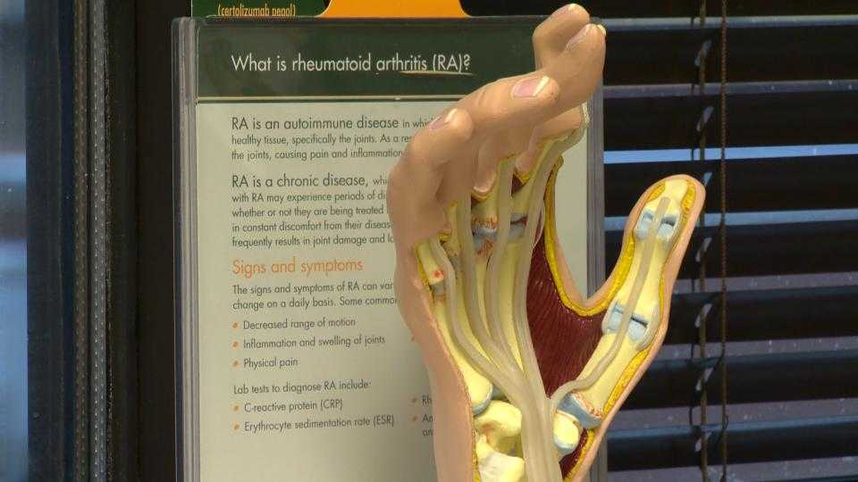 Woman's Doctor: Know symptoms of rheumatoid arthritis because it's treatable