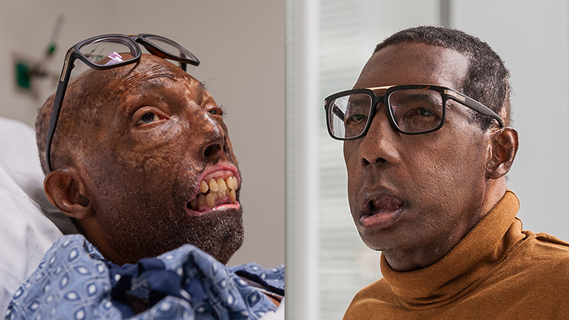 Meet the First African-American Face Transplant Recipient