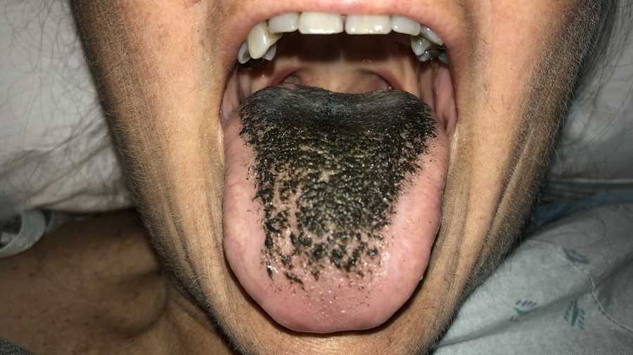 A condition known as black hairy tongue has been linked with certain medications, conditions and poor oral health.