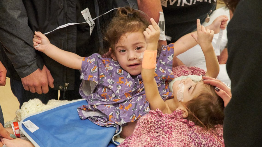 California Conjoined Twins Successfully Separated