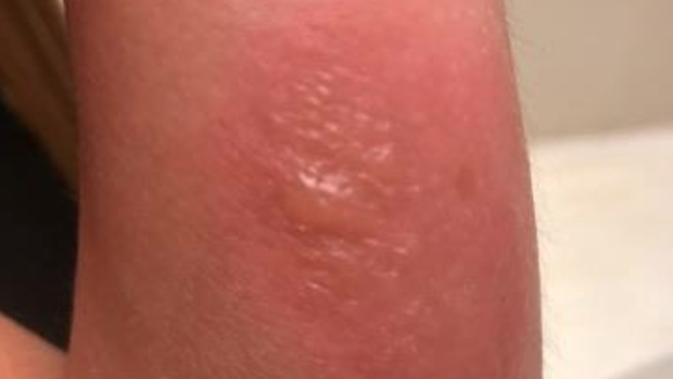 that has blistered bug bite