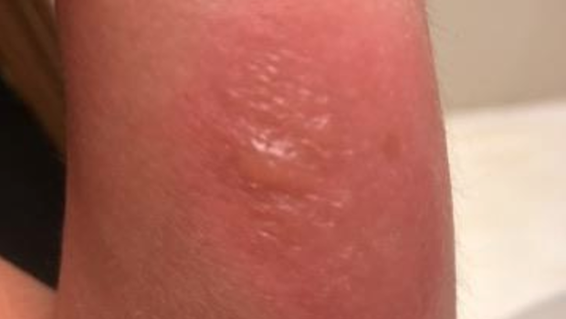 Woman Treated For Bubbling Infected Brown Recluse Spider Bite
