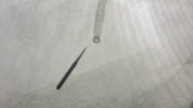 Doctors perform ﻿rare medical procedure after patient inhales 1-inch dental drill bit in Wisconsin - Vimarsana News