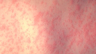 Alabama health experts encourage Measles vaccine for kids following series of outbreaks - Vimarsana News