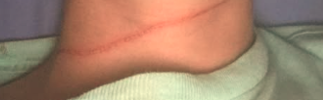 ﻿A gash in an ATV rider's neck that he claims is from an encounter with barbed wire nearly a year ago.
