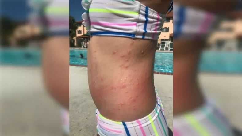 Mother believes sea lice from Carolina Beach caused irritating rash