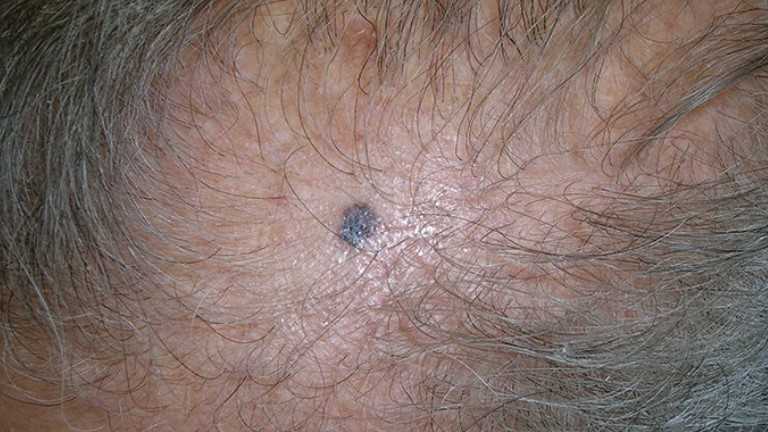 医師によると、皮膚がんをチェックする驚くべき場所