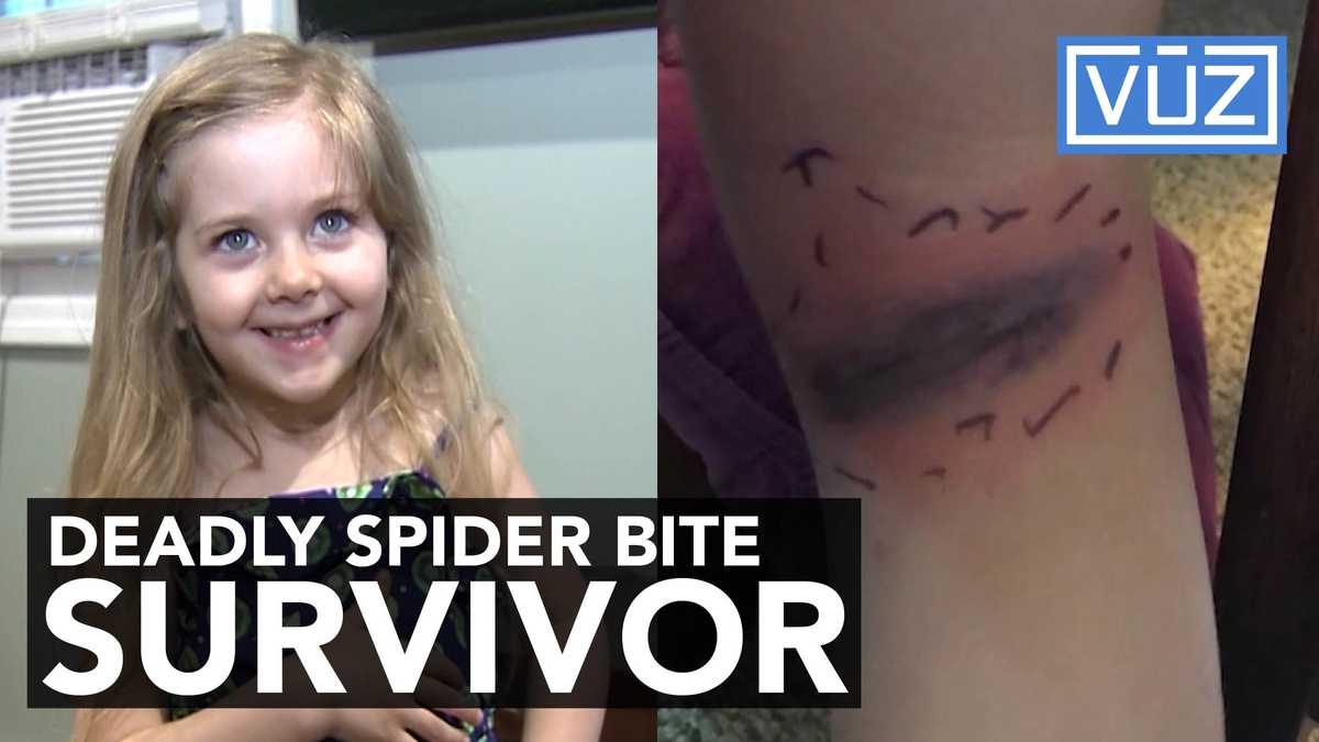 Girl hospitalized after black widow spider bite