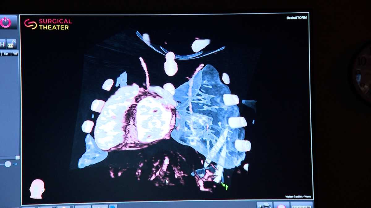 Project CommUNITY: Norton Children's using groundbreaking technology to repair heart conditions