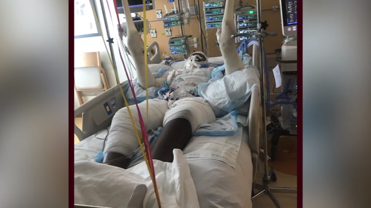 Michigan girl to spend months in hospital after 'fire challenge' gone awry