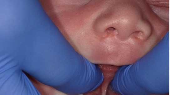 Children born with tongue-tie may suffer difficulty with nursing, speech - Vimarsana News