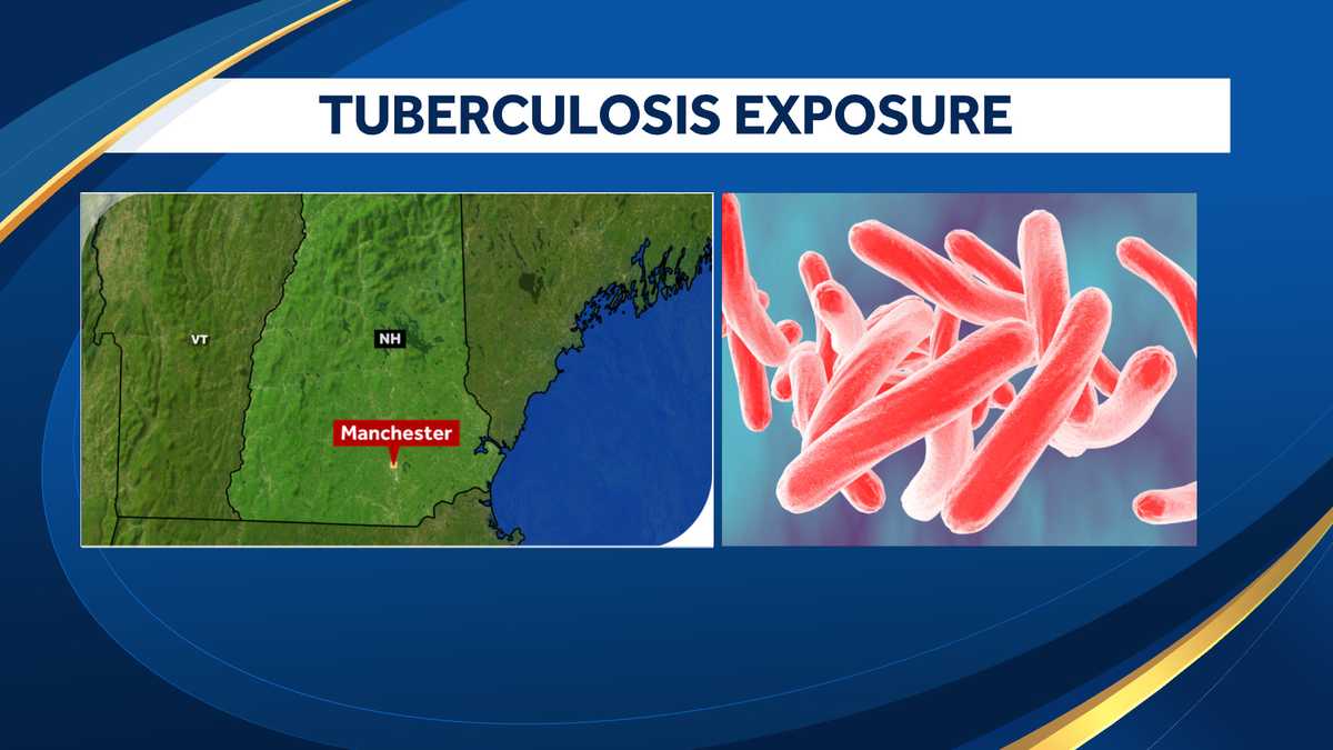 Bambini e personale sono stati esposti alla tubercolosi in una struttura per l'infanzia nel New Hampshire