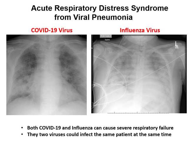 COVID-19 INFLUENZA COVID-19 INFLUENZA