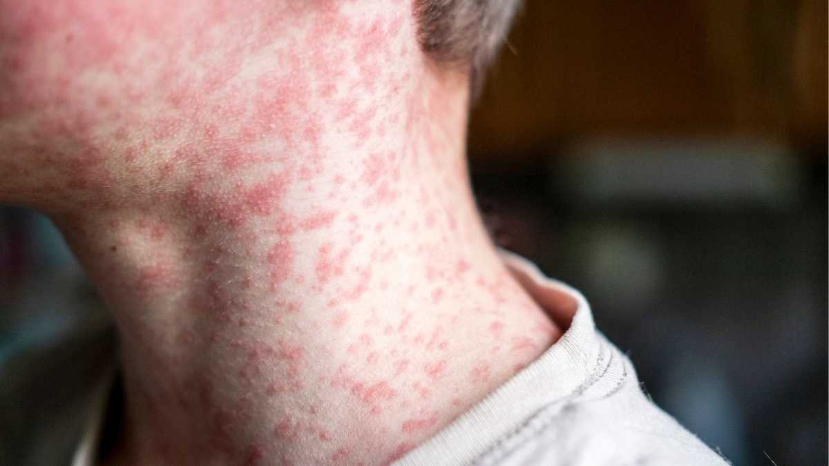 Kentucky health officials report first case of measles in 2026