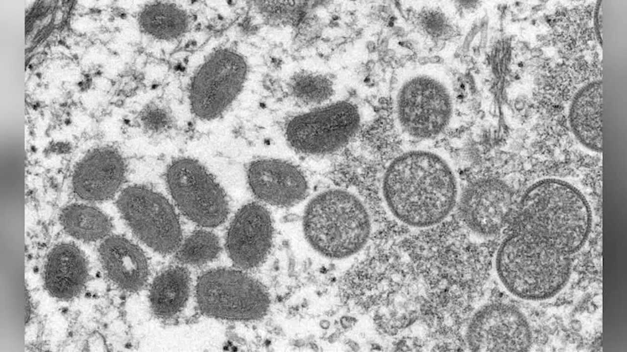 First United States case of monkeypox in 2022 confirmed by Massachusetts health officials