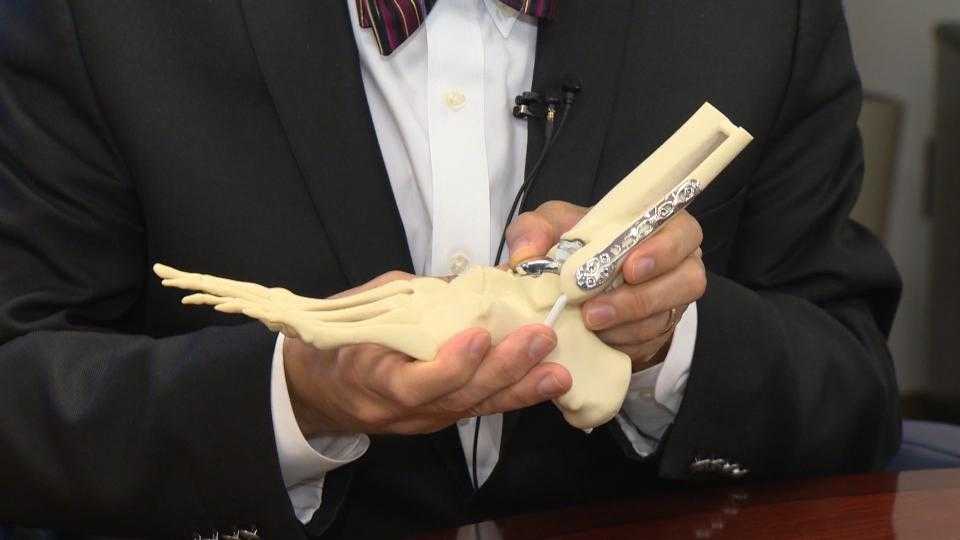 Woman's Doctor: Ankle replacement surgery life-changing for some