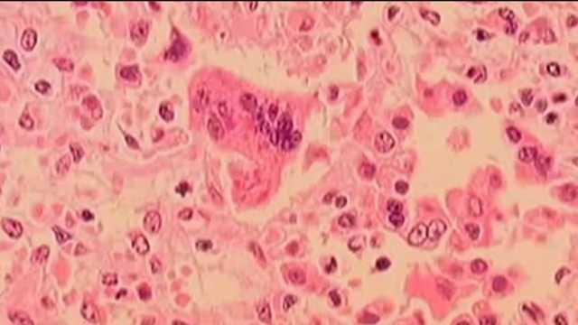 New England state reports its first measles case since 2019 - Vimarsana News