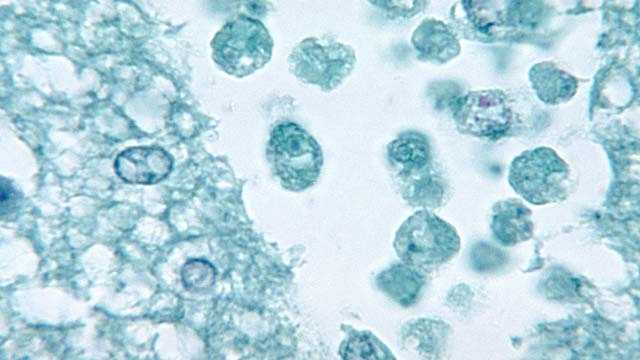 Water tests positive for brain-eating amoeba in area of Terrebonne Parish