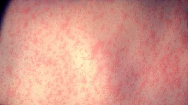 Health Department reports case of measles in the city of Pittsburgh - WTAE Pittsburgh thumbnail