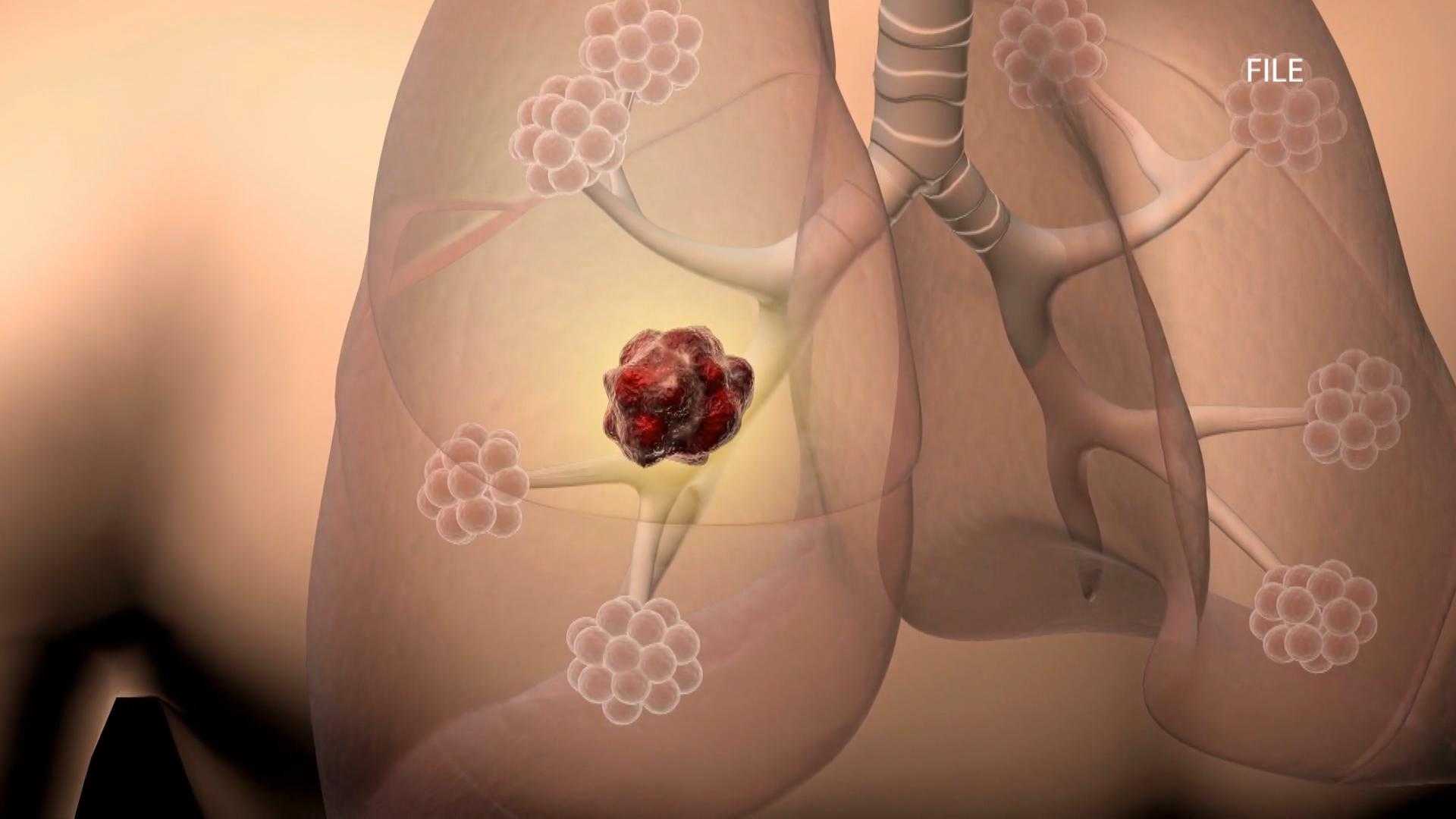 Woman thriving years after Stage 4 lung cancer diagnosis | Here's how