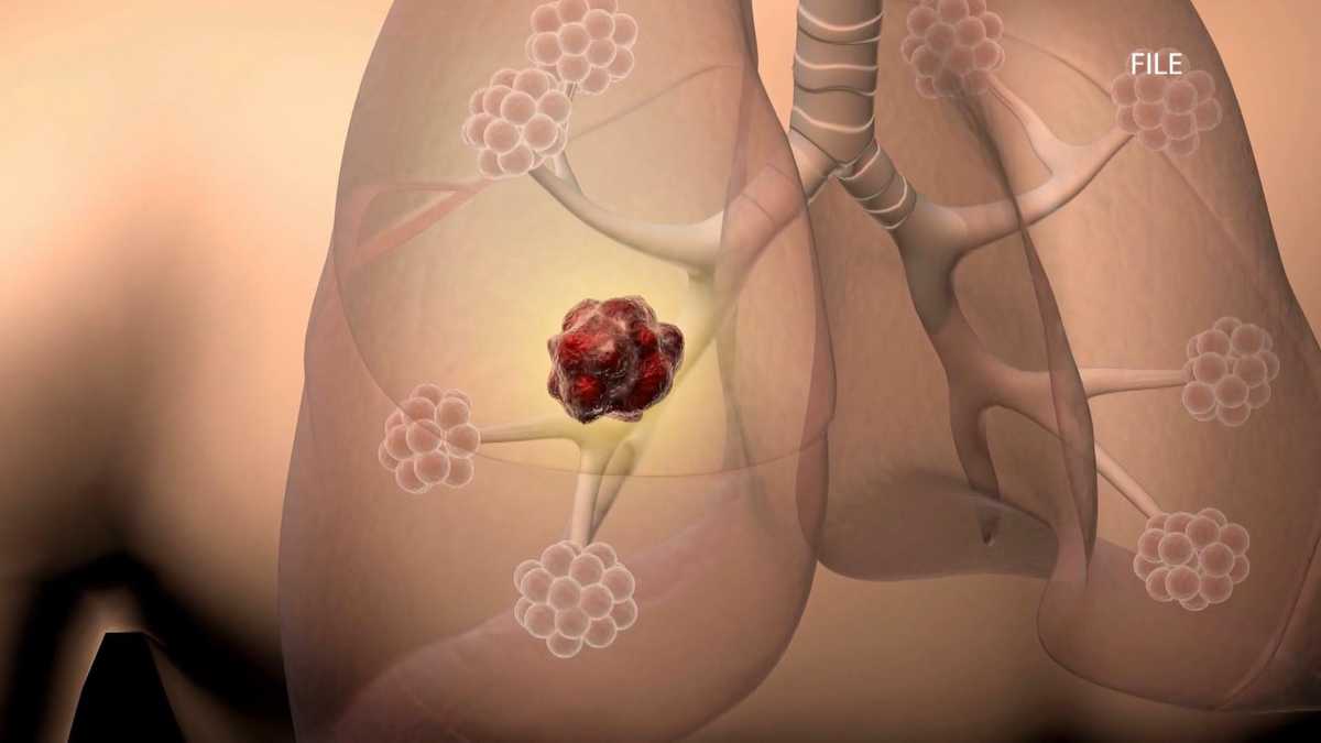 Woman thriving years after Stage 4 lung cancer diagnosis | Here's how