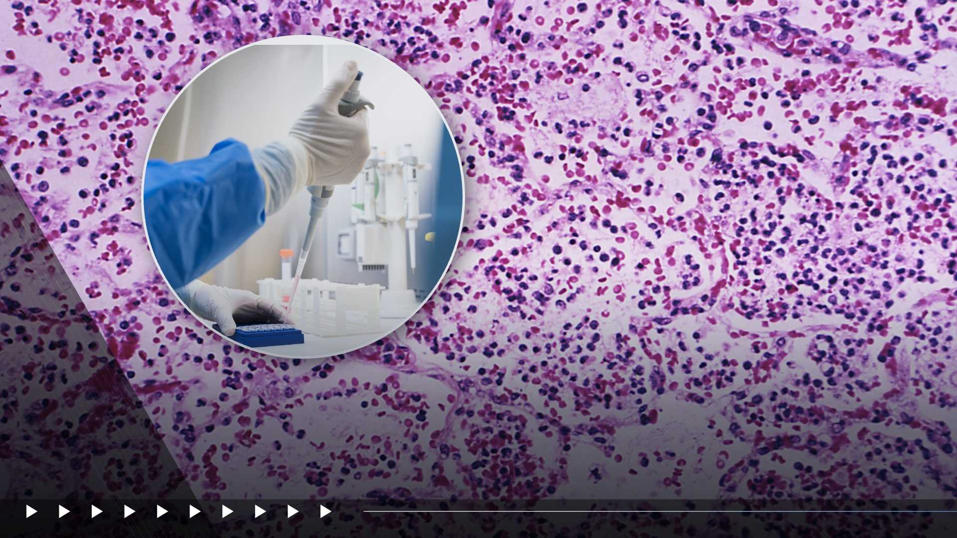 US monitoring suspected plague death in Russia. Here's what to know